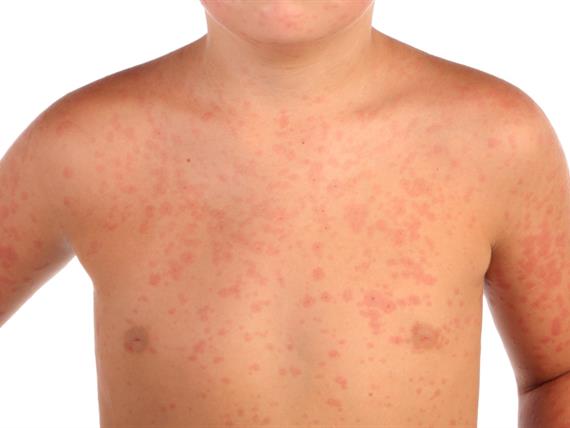 Tutto ciò che bisogna sapere sul Morbillo
